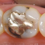 bruxzir-solid-zirconia-crowns-bridges-1