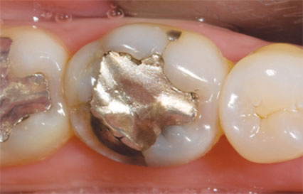 bruxzir-solid-zirconia-crowns-bridges-1