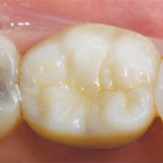 bruxzir-solid-zirconia-crowns-bridges-2 (1)