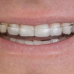 after-comfort-bite-splint-2