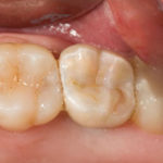 after-implant-restorations-2