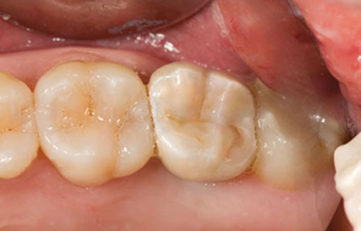 after-implant-restorations-2
