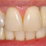 after-inclusive-custom-implant-abutments-2