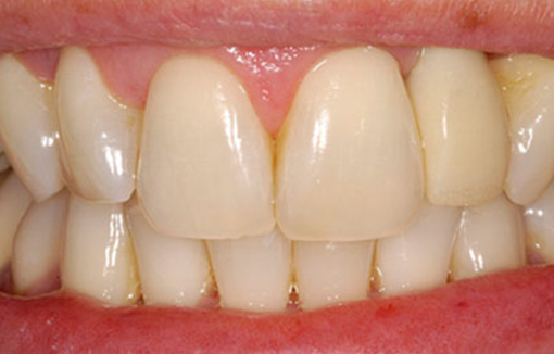 after-inclusive-custom-implant-abutments-2
