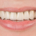after-ips-emax-2