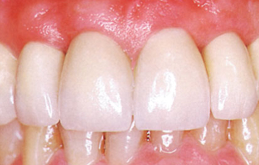 after-occlusal-gold-2