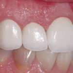 after-prismatik-clinical-zirconia-2