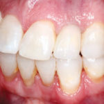 after-screw-retained