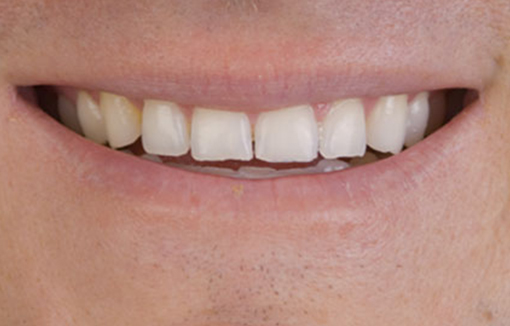 before-comfort-bite-splint-1