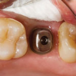 before-implant-restorations-1