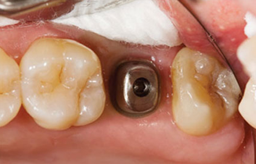 before-implant-restorations-1