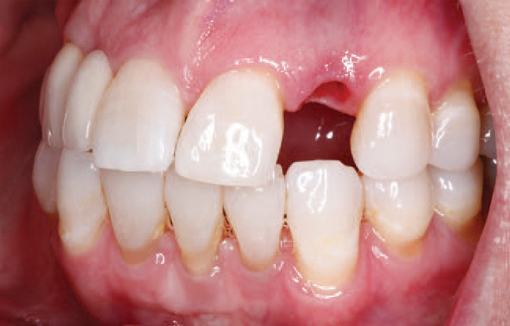 before-screw-retained