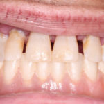 before_bruxzir_full_arch