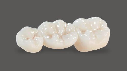 Screw-Retained Crowns - Riverside Dental Ceramics