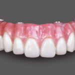 bruxzir_full_arch_image1_860x485