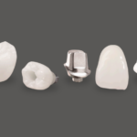 implant-restorations