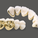 occlusal-gold