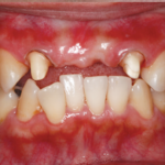 occlusal_before
