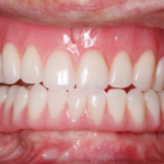 implant_overdentures_after