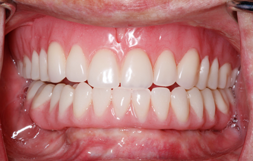 implant_overdentures_after