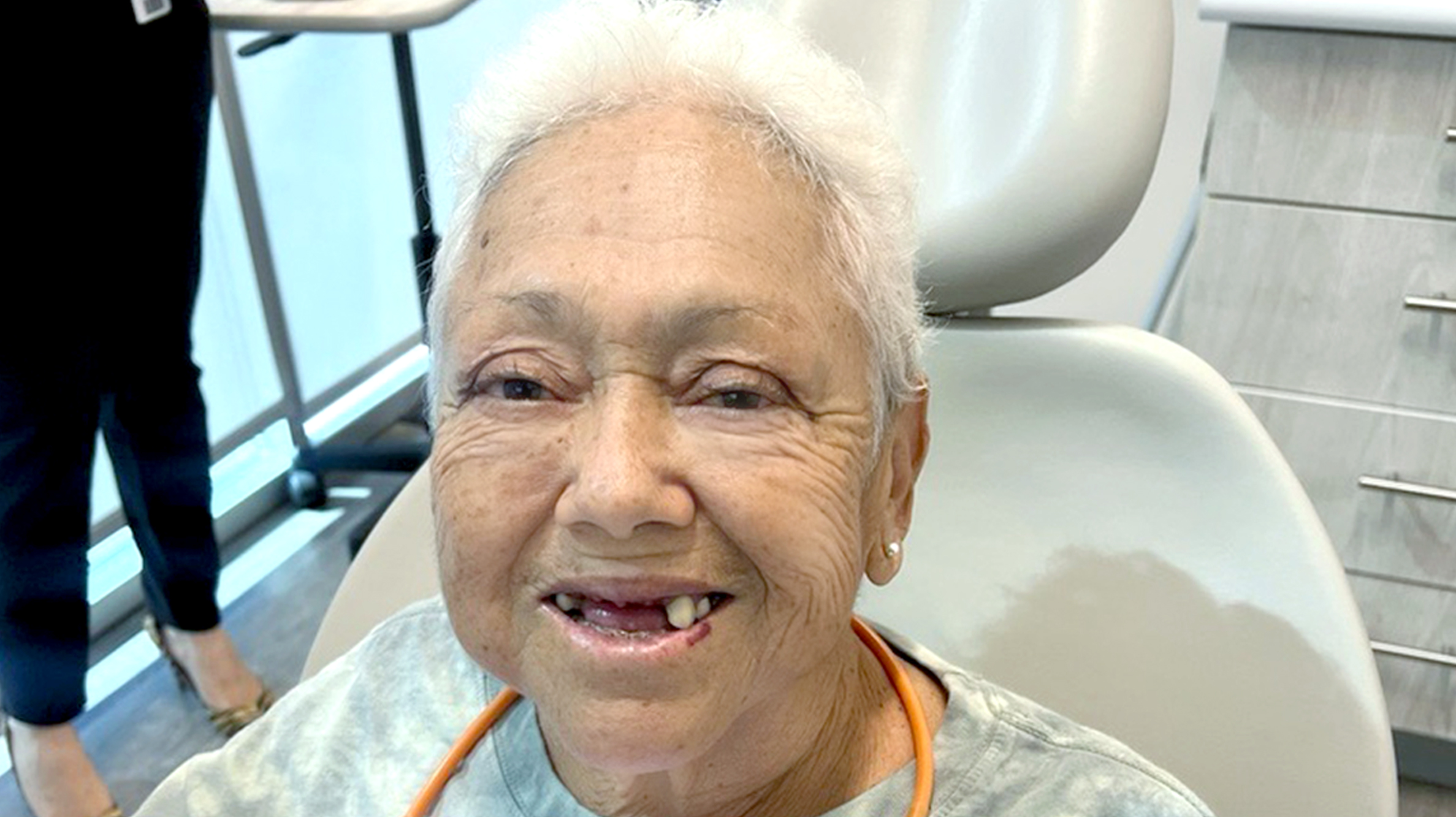 Patient's smile line with missing teeth #6–10.