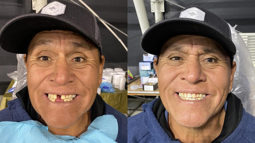 Before and after of another patient with a teeth restoration